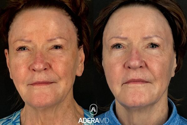 BBL & Moxi (Total of 1 Treatment)