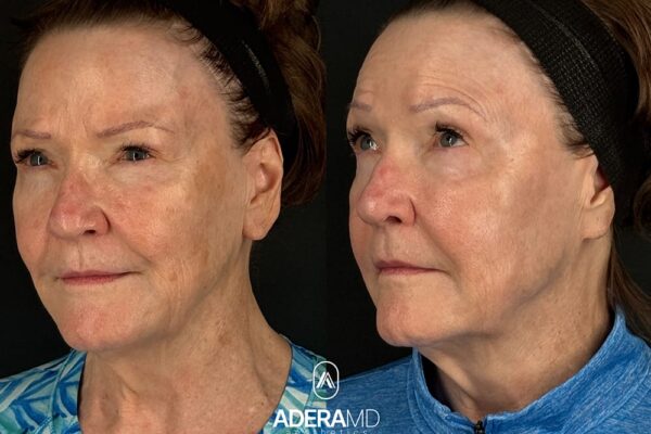 BBL & Moxi (Total of 1 Treatment)