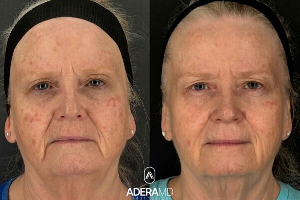 Gray B&A (frontal)