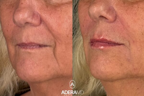 Uram B&A (Left 45)
