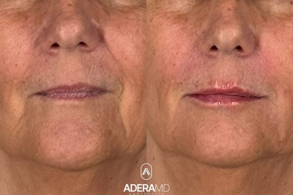 Uram B&A (close frontal)