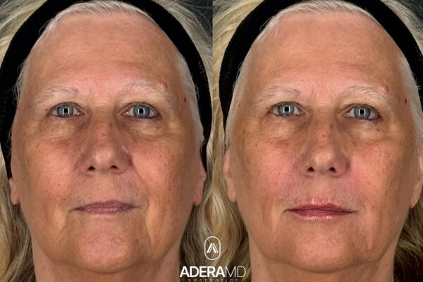 Uram B&A (frontal)