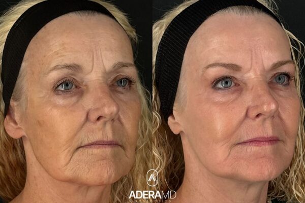 Rickle B&A (45)