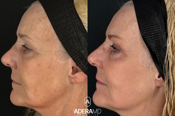 Rickle B&A (90)